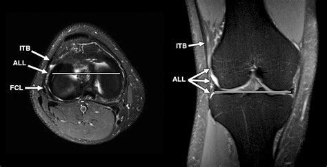 fibular ligament test results